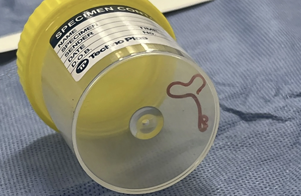 Neurosurgeon investigating mystery symptoms pulls 3-inch worm from woman's brain